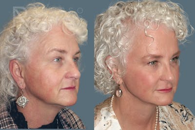Liquid Facelift Before & After Gallery - Patient 147739142 - Image 1