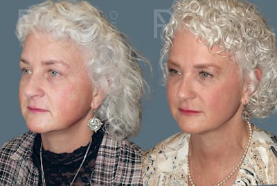 Liquid Facelift Before & After Gallery - Patient 147739142 - Image 2