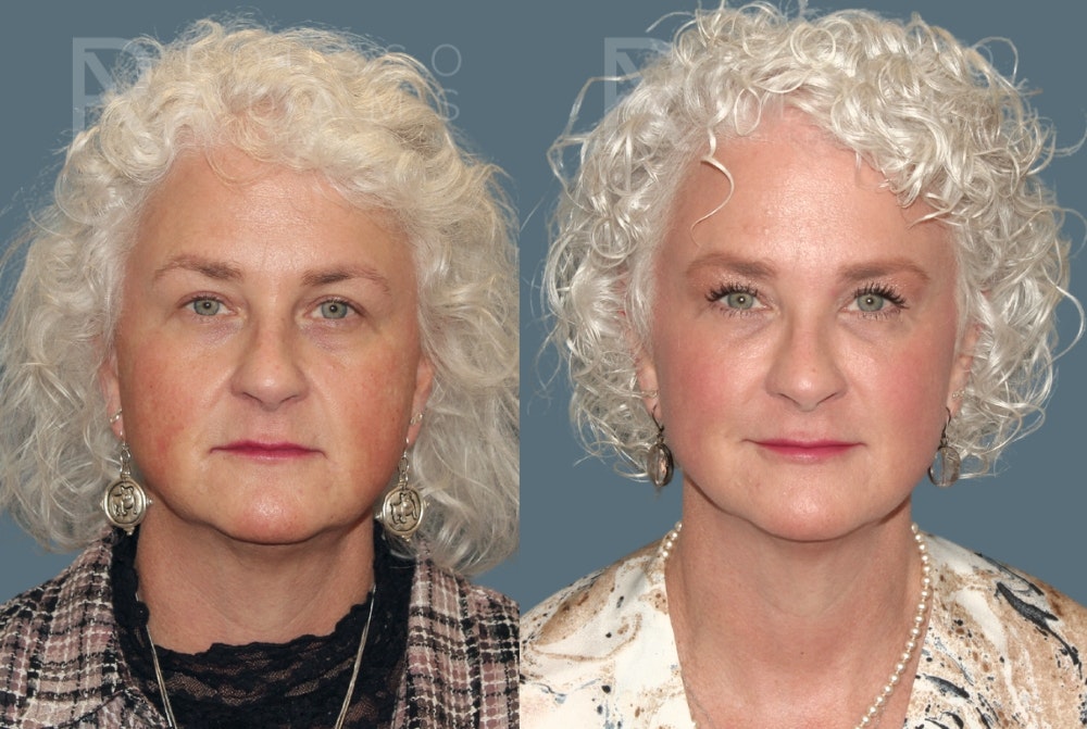 Liquid Facelift Before & After Gallery - Patient 147739142 - Image 3