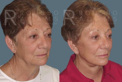 SculptLift™ <span class=small>By Dr. Daniel Rousso</span> Before & After Gallery - Patient 26207227 - Image 1