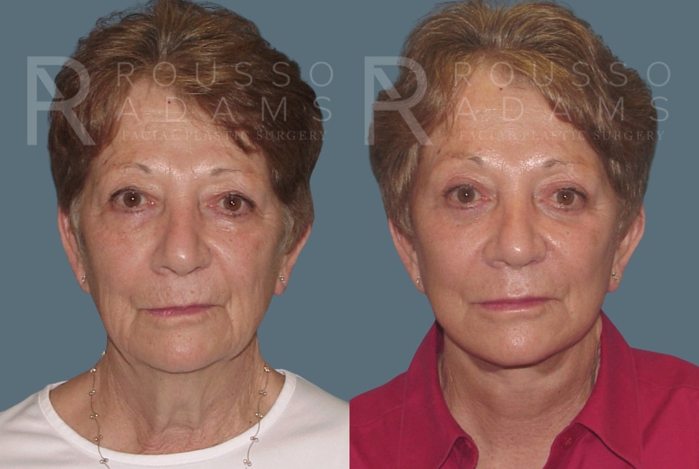 SculptLift™ <span class=small>By Dr. Daniel Rousso</span> Before & After Gallery - Patient 26207227 - Image 2