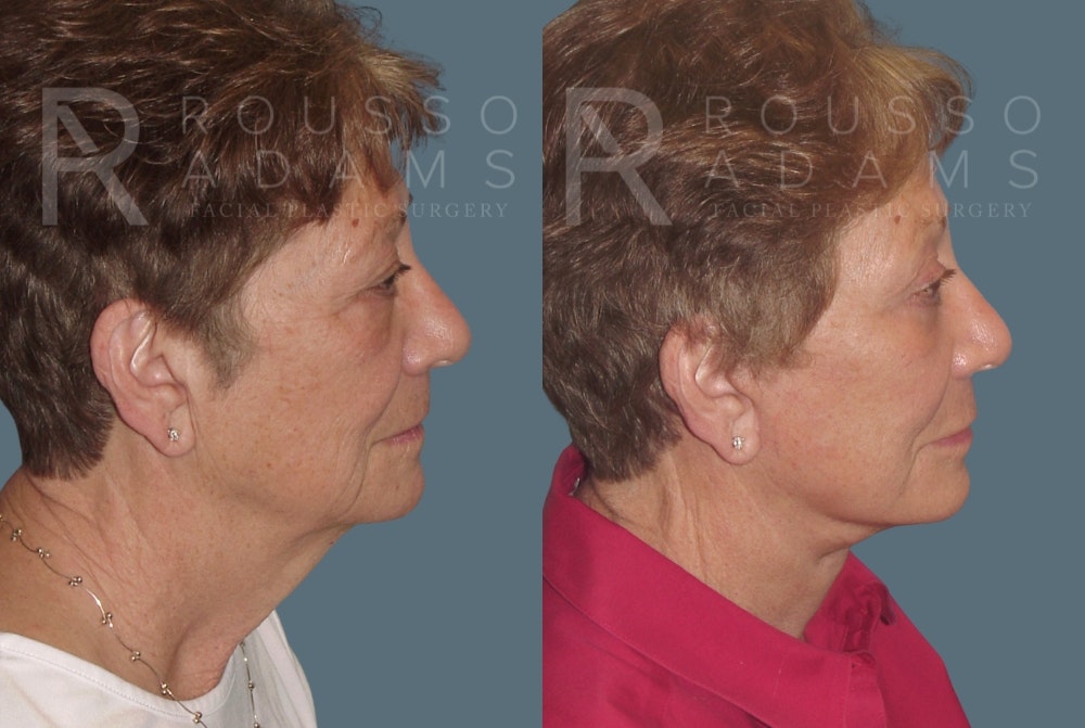 SculptLift™ <span class=small>By Dr. Daniel Rousso</span> Before & After Gallery - Patient 26207227 - Image 3