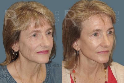 Facelift - Dr. Rousso Before & After Gallery - Patient 148128970 - Image 1