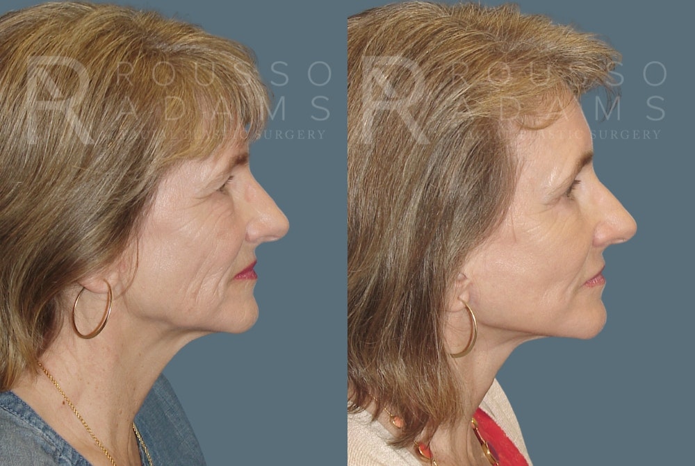 Facelift - Dr. Rousso Before & After Gallery - Patient 148128970 - Image 2