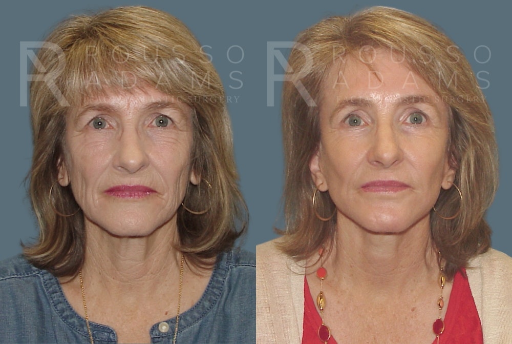 Facelift - Dr. Rousso Before & After Gallery - Patient 148128970 - Image 3