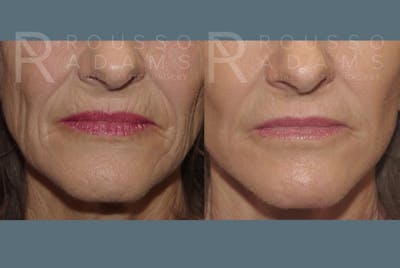 Facelift Before & After Gallery - Patient 148128970 - Image 4