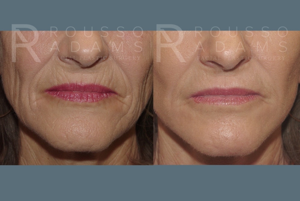 Facelift Before & After Gallery - Patient 148128970 - Image 4