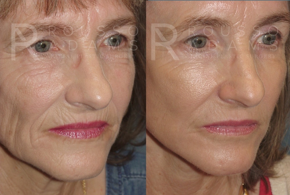 Facelift Before & After Gallery - Patient 148128970 - Image 5