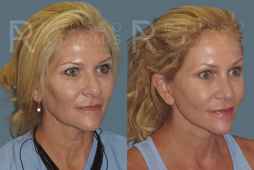 Facelift - Dr. Rousso Before & After Gallery - Patient 148128971 - Image 1
