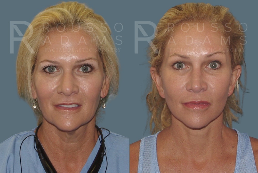 Facelift Before & After Gallery - Patient 148128971 - Image 2