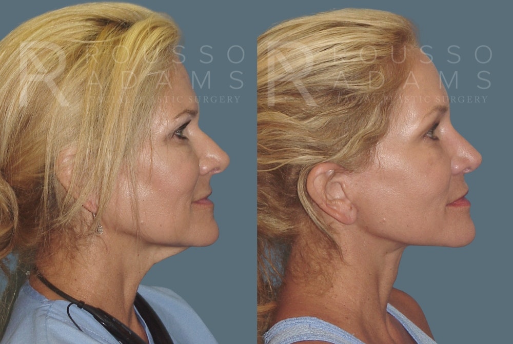 Facelift Before & After Gallery - Patient 148128971 - Image 3