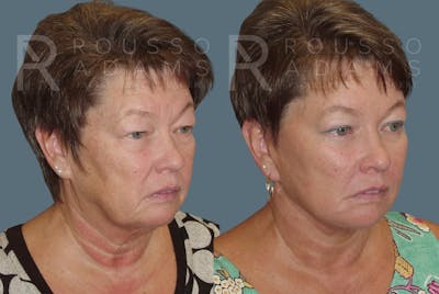 Facelift Before & After Gallery - Patient 148128972 - Image 1