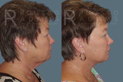 Facelift - Dr. Rousso Before & After Gallery - Patient 148128972 - Image 2