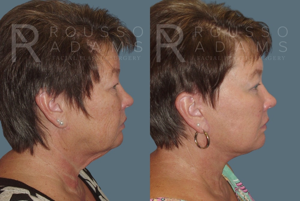 Facelift <span class=small>By Dr. Daniel Rousso</span> Before & After Gallery - Patient 148128972 - Image 2