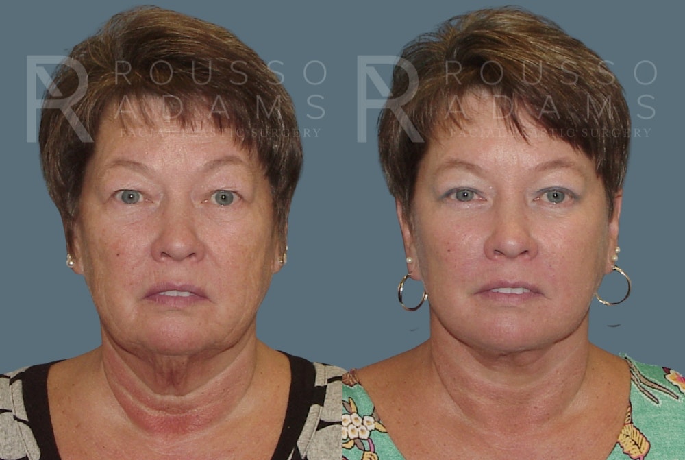 Facelift <span class=small>By Dr. Daniel Rousso</span> Before & After Gallery - Patient 148128972 - Image 3