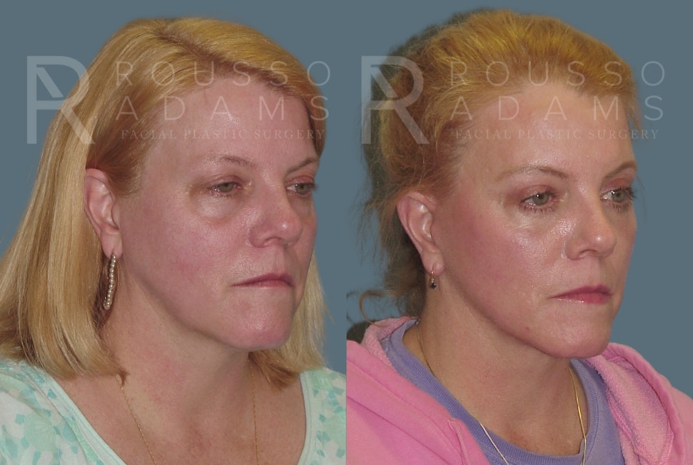 MiniLift Before & After Gallery - Patient 148128976 - Image 2