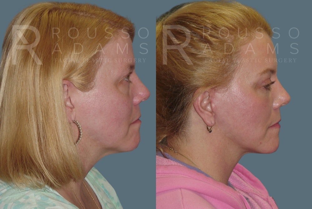MiniLift Before & After Gallery - Patient 148128976 - Image 3