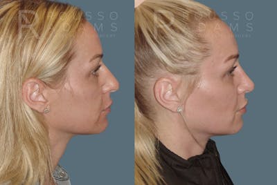 Rhinoplasty<span class=small>By Dr. Austin Adams</span> Before & After Gallery - Patient 148864341 - Image 1
