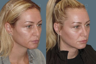 Rhinoplasty<span class=small>By Dr. Austin Adams</span> Before & After Gallery - Patient 148864341 - Image 2