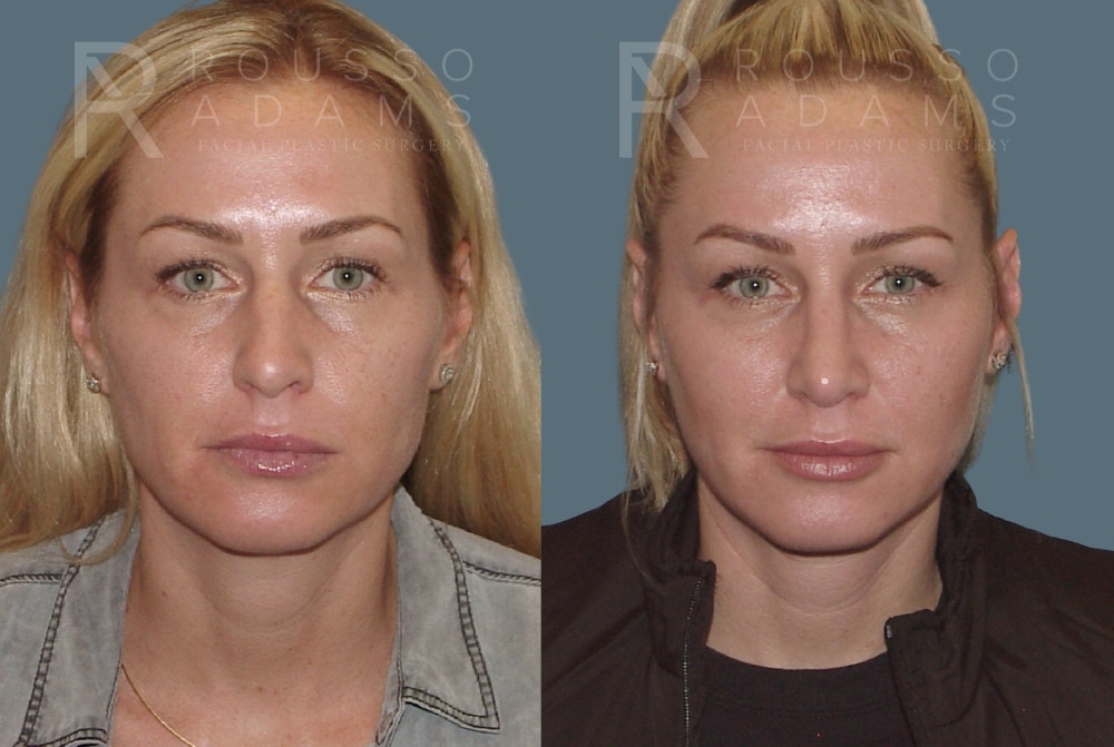 Rhinoplasty<span class=small>By Dr. Austin Adams</span> Before & After Gallery - Patient 148864341 - Image 3