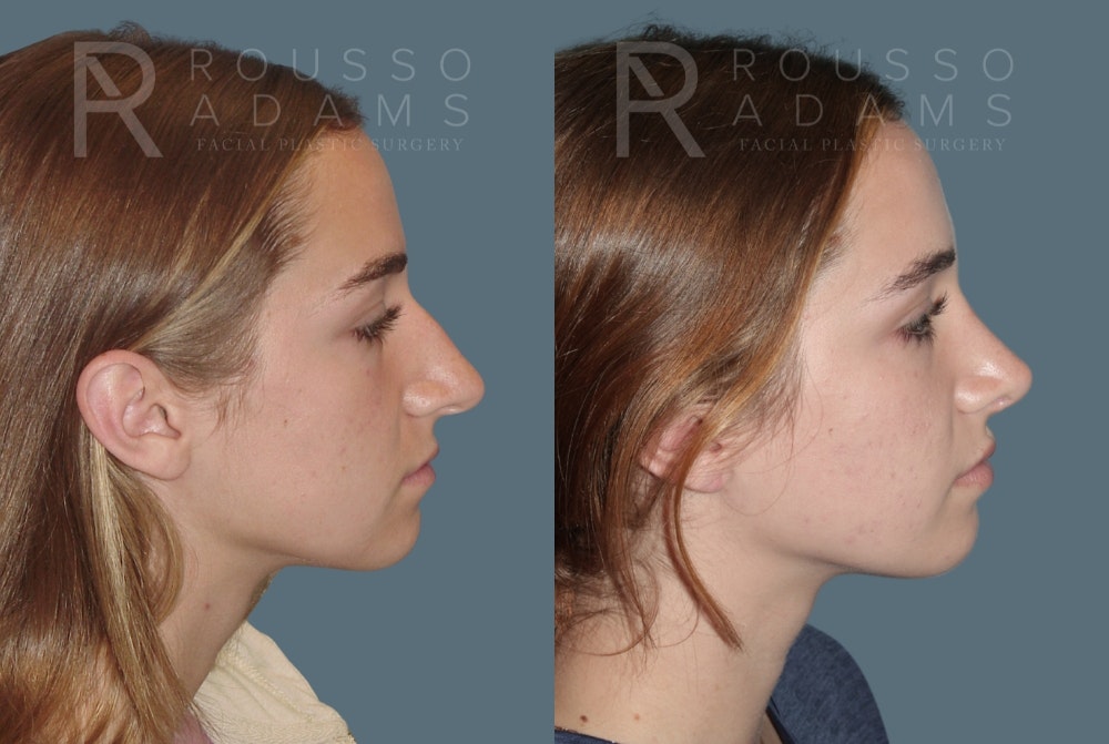Rhinoplasty Before & After Gallery - Patient 148864340 - Image 1