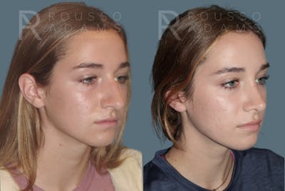 Rhinoplasty<span class=small>By Dr. Austin Adams</span> Before & After Gallery - Patient 148864340 - Image 2