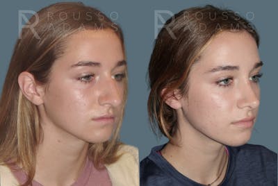 Rhinoplasty Before & After Gallery - Patient 148864340 - Image 2