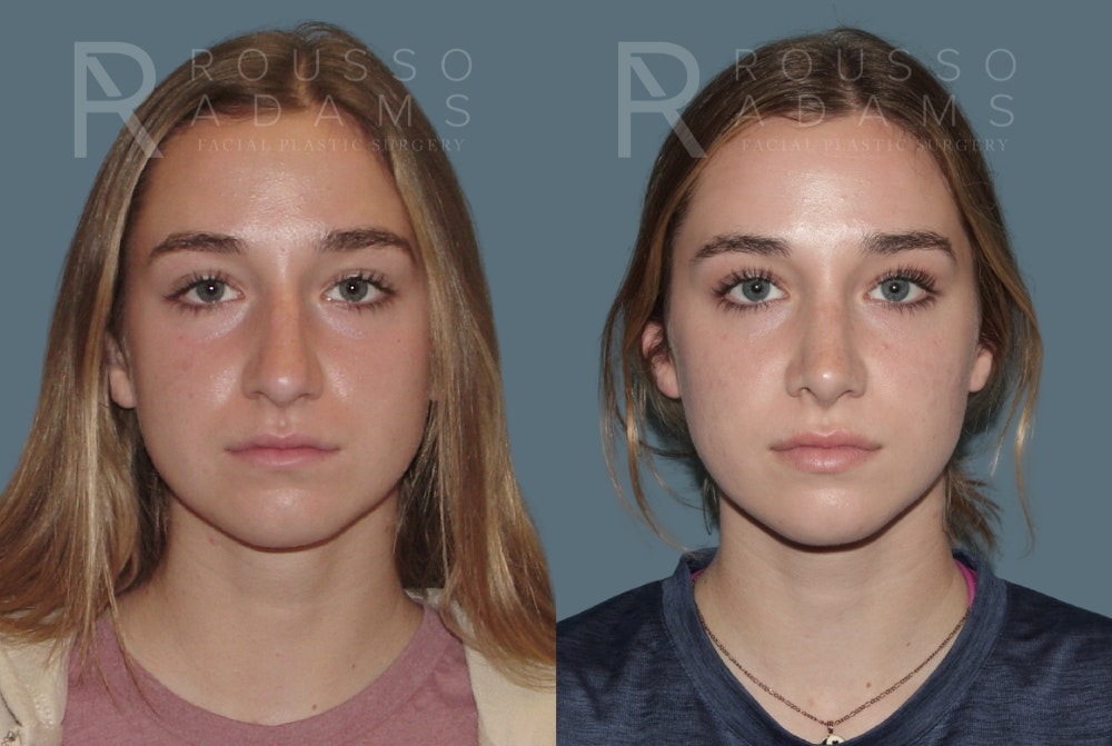 Rhinoplasty<span class=small>By Dr. Austin Adams</span> Before & After Gallery - Patient 148864340 - Image 3