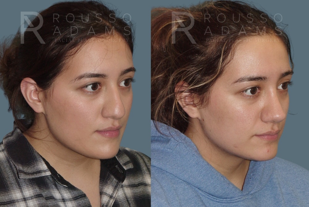 Rhinoplasty Before & After Gallery - Patient 148864339 - Image 2