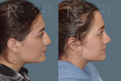 Rhinoplasty Before & After Gallery - Patient 148864339 - Image 1