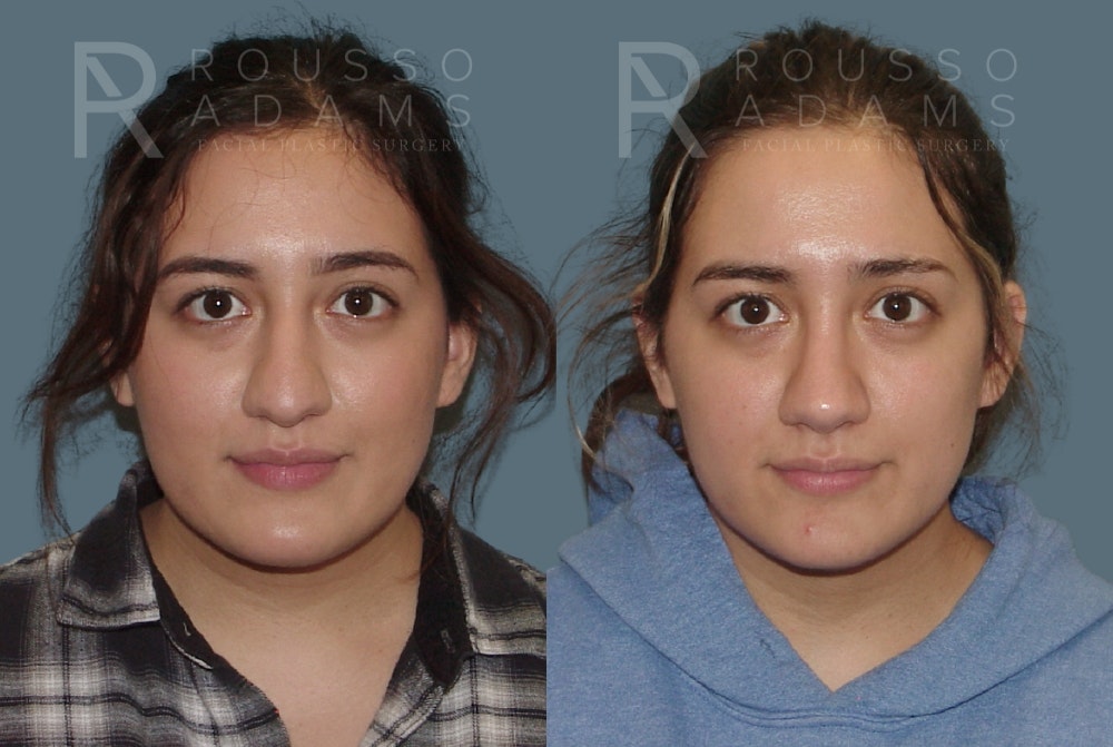 Rhinoplasty<span class=small>By Dr. Austin Adams</span> Before & After Gallery - Patient 148864339 - Image 3