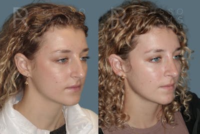 Rhinoplasty Before & After Gallery - Patient 148864344 - Image 2