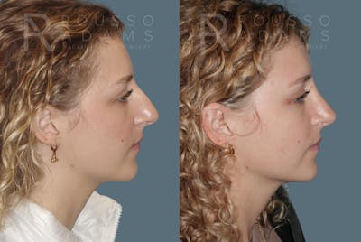 Rhinoplasty Before & After Gallery - Patient 148864344 - Image 1