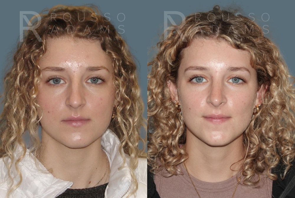 Rhinoplasty Before & After Gallery - Patient 148864344 - Image 3