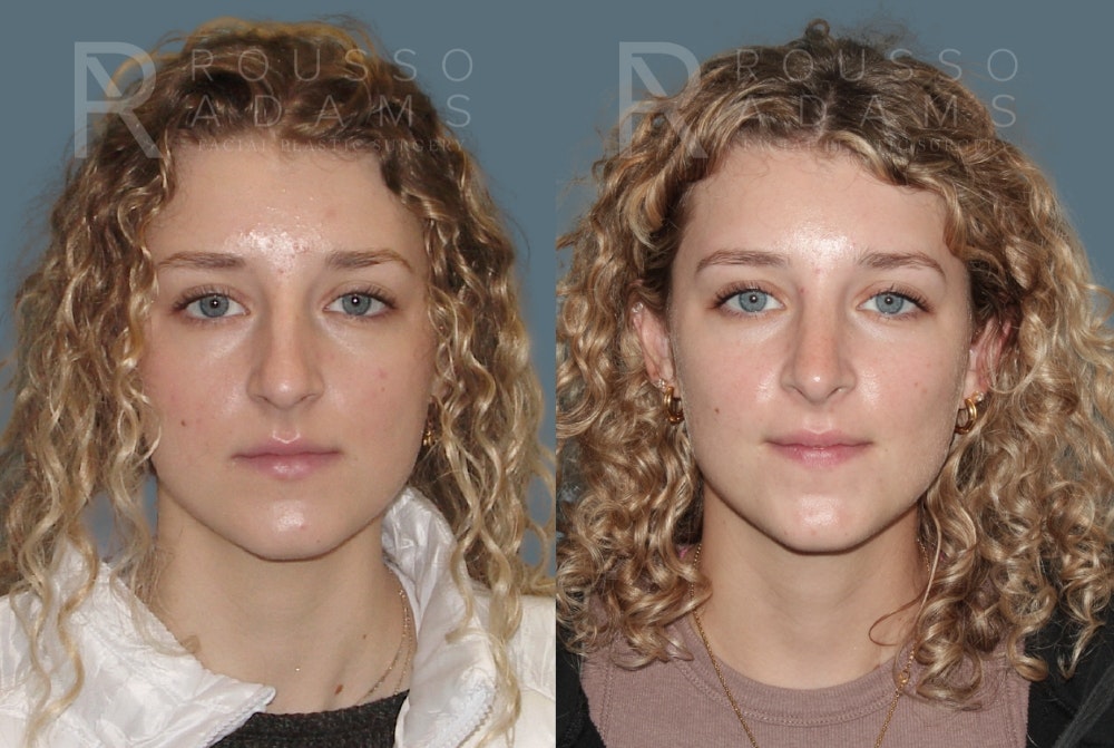 Rhinoplasty<span class=small>By Dr. Austin Adams</span> Before & After Gallery - Patient 148864344 - Image 3