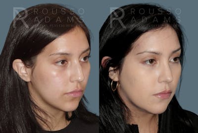 Rhinoplasty Before & After Gallery - Patient 148864347 - Image 2