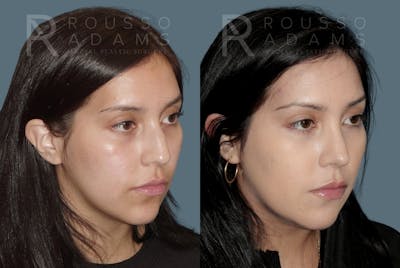 Rhinoplasty<span class=small>By Dr. Austin Adams</span> Before & After Gallery - Patient 148864347 - Image 2