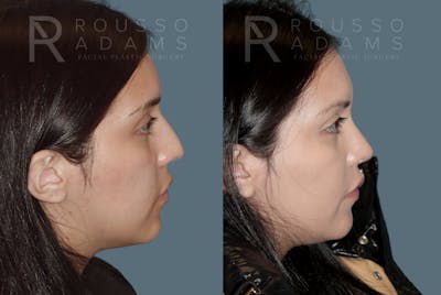 Rhinoplasty Before & After Gallery - Patient 148864347 - Image 1