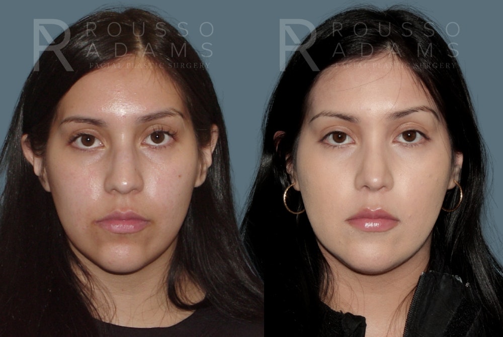 Rhinoplasty Before & After Gallery - Patient 148864347 - Image 3