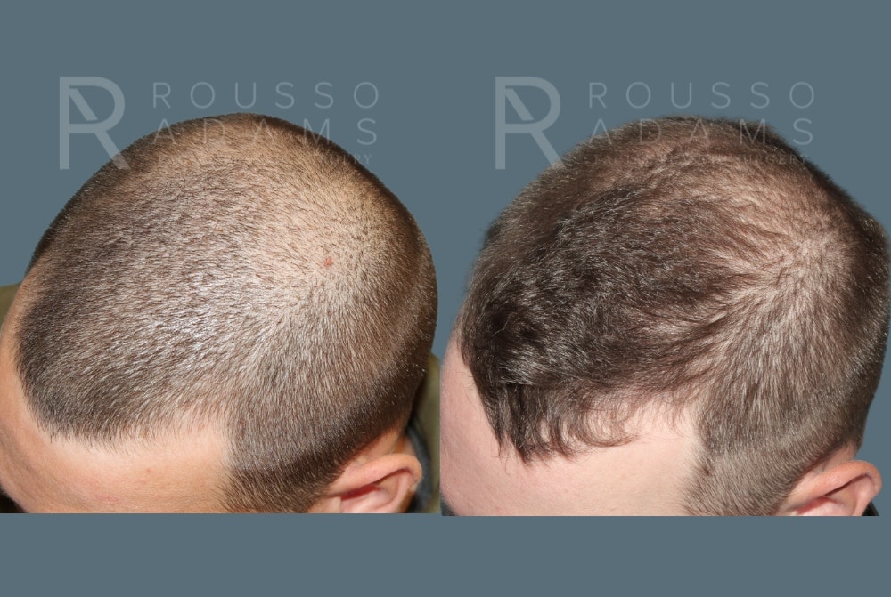 Hair Transplant Before & After Gallery - Patient 149283979 - Image 3