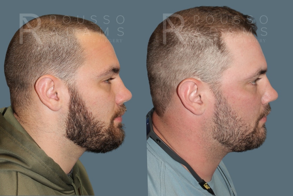 Hair Transplant Before & After Gallery - Patient 149283979 - Image 1