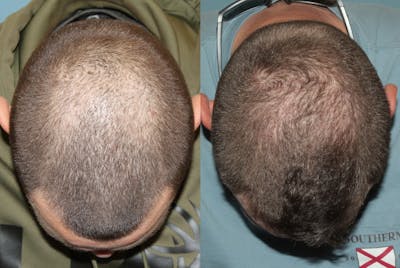 Hair Transplant Before & After Gallery - Patient 149283979 - Image 4