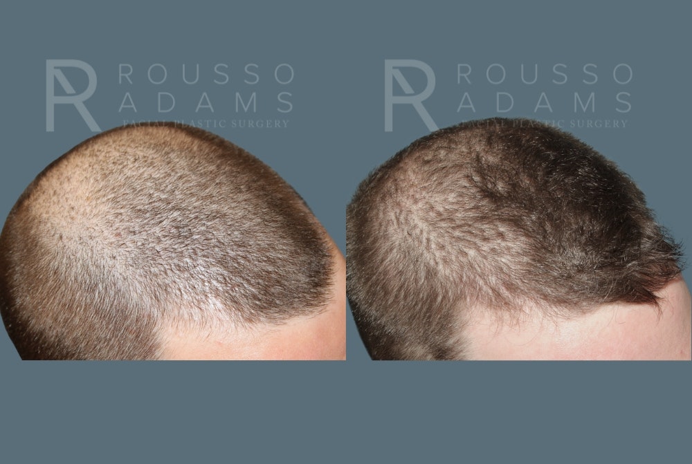 Hair Transplant Before & After Gallery - Patient 149283979 - Image 5