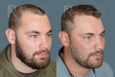 Hair Transplant Before & After Gallery - Patient 149283979 - Image 2