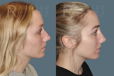 Liquid Rhinoplasty Before & After Gallery - Patient 149283982 - Image 1