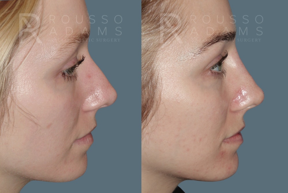 Liquid Rhinoplasty Before & After Gallery - Patient 149283982 - Image 2
