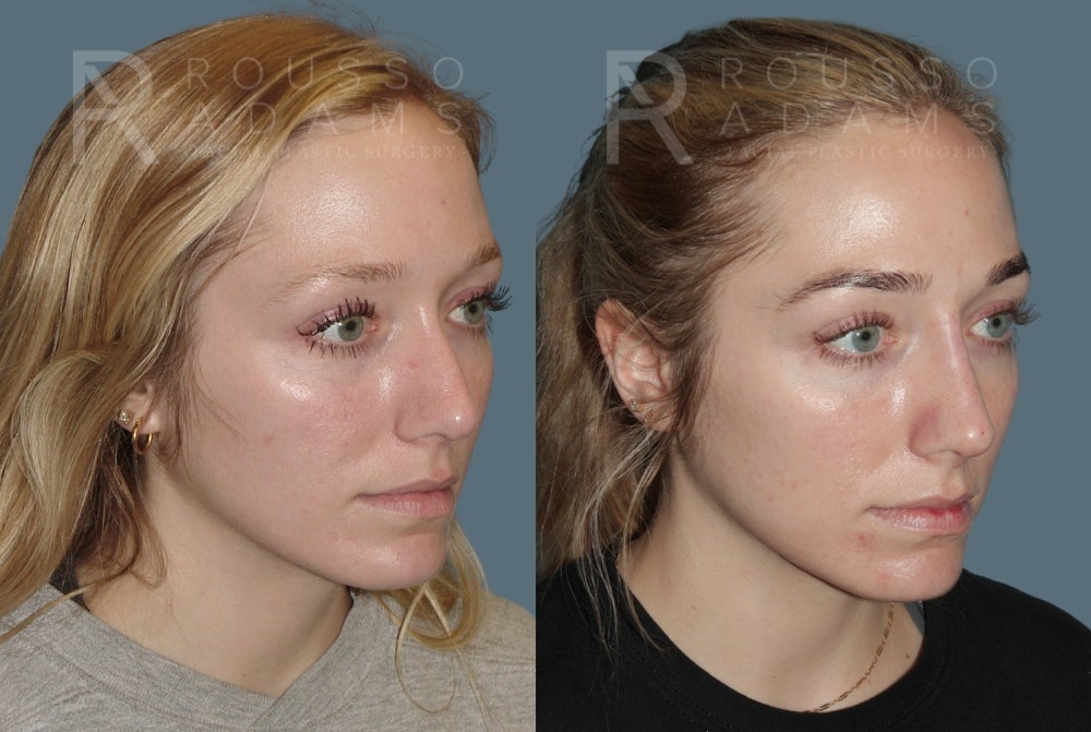 Liquid Rhinoplasty Before & After Gallery - Patient 149283982 - Image 3
