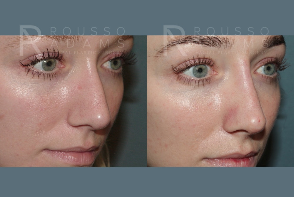 Liquid Rhinoplasty Before & After Gallery - Patient 149283982 - Image 4