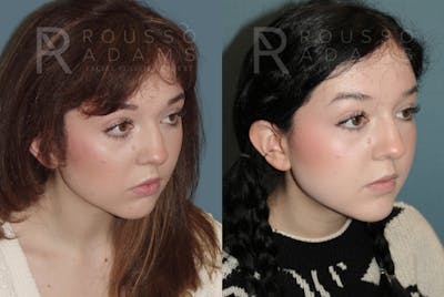 Facial Implants <span class=small>By Dr. Daniel Rousso</span> Before & After Gallery - Patient 149283992 - Image 1