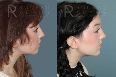 Facial Implants <span class=small>By Dr. Daniel Rousso</span> Before & After Gallery - Patient 149283992 - Image 2